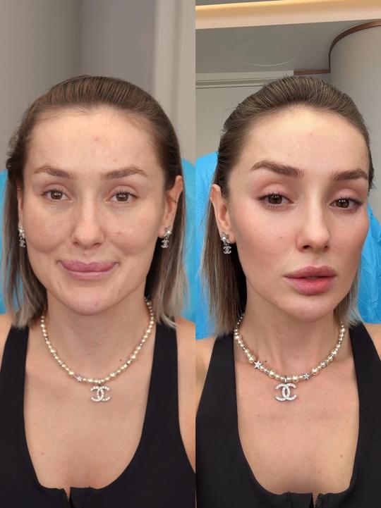 Case 03, Minimally Invasive Tri-Plane Lift Rejuvenation before and after