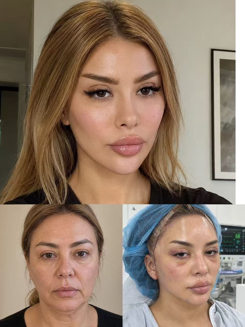 Case 06, Tri-Plane Facelift before and after