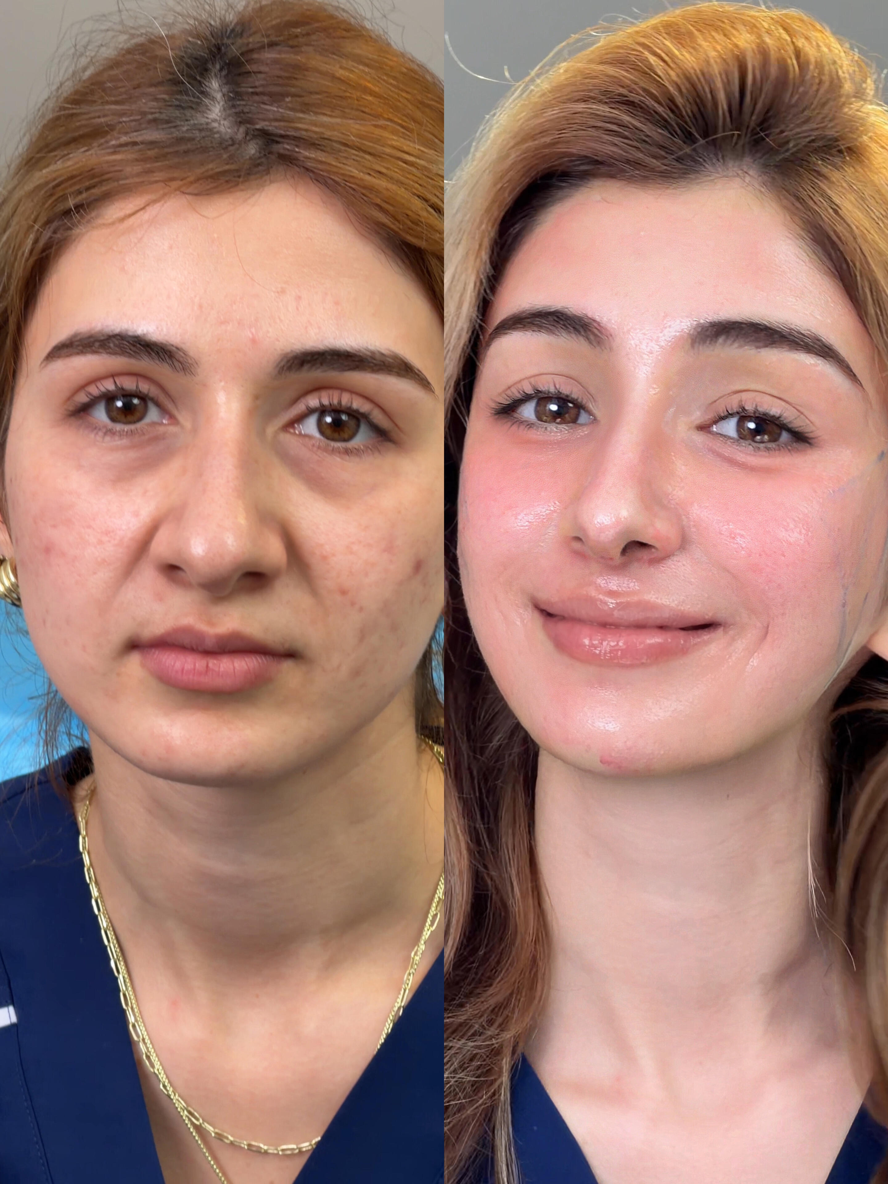 Case 09, Minimally Invasive Tri-Plane Lift before and after