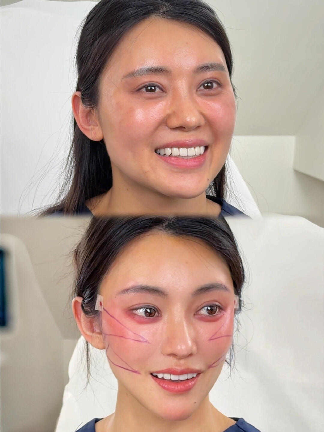 Case 10, Minimally Invasive Tri-Plane Lift before and after