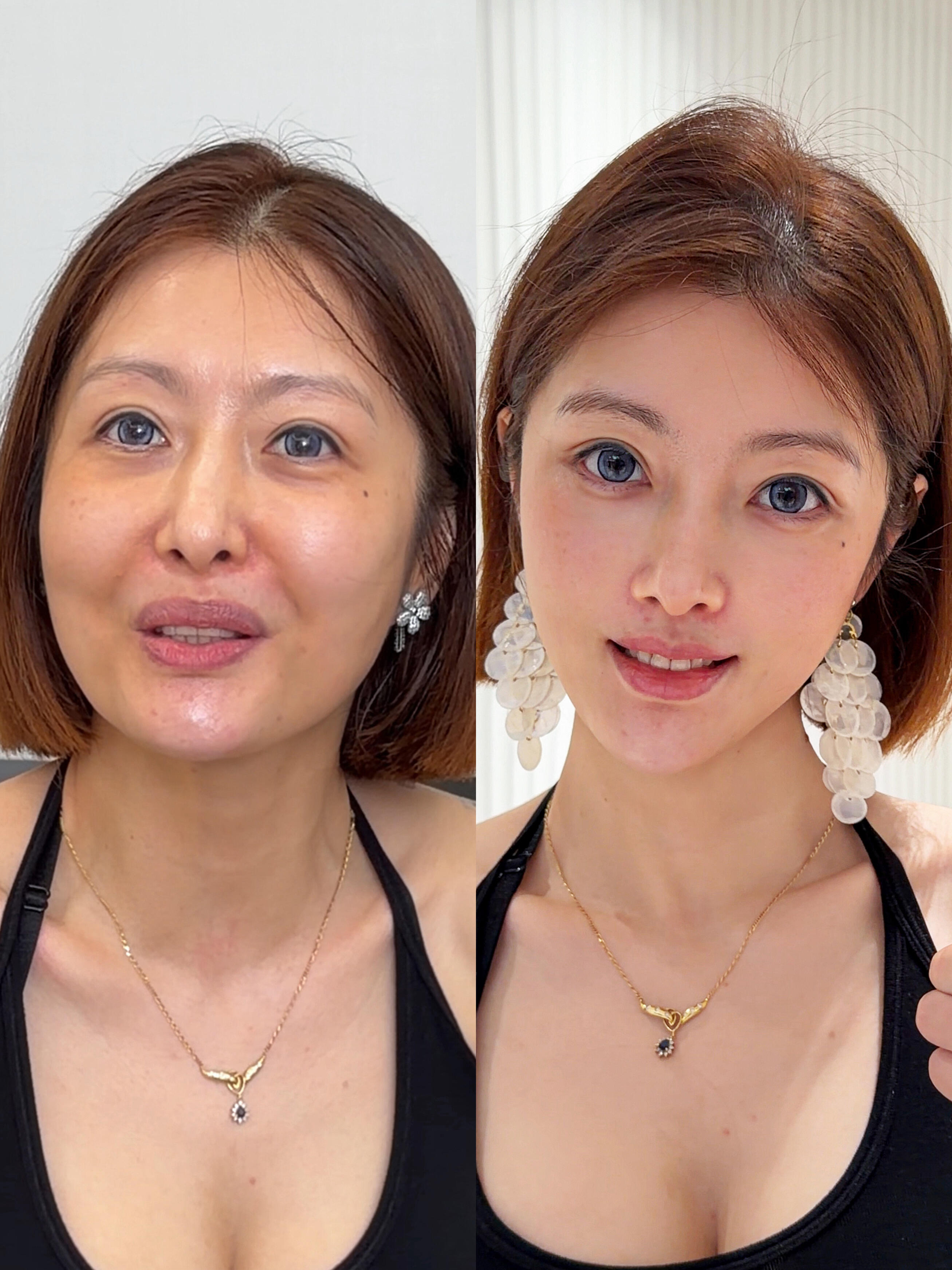 Case 11, Minimally Invasive Tri-Plane Lift before and after